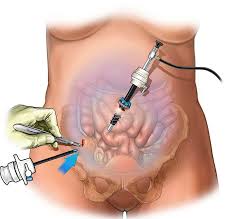 Laparoscopic Surgery- Nephrectomy, Pyeloplasty Treatment Services